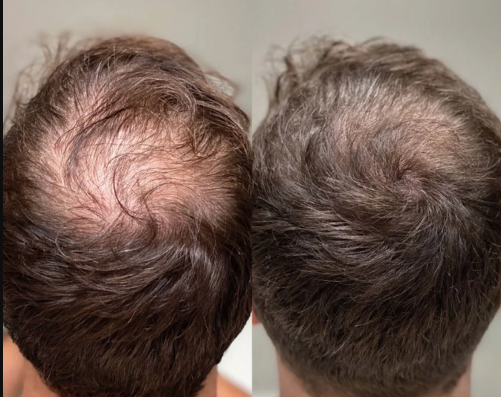 Customer one month hair progress photo