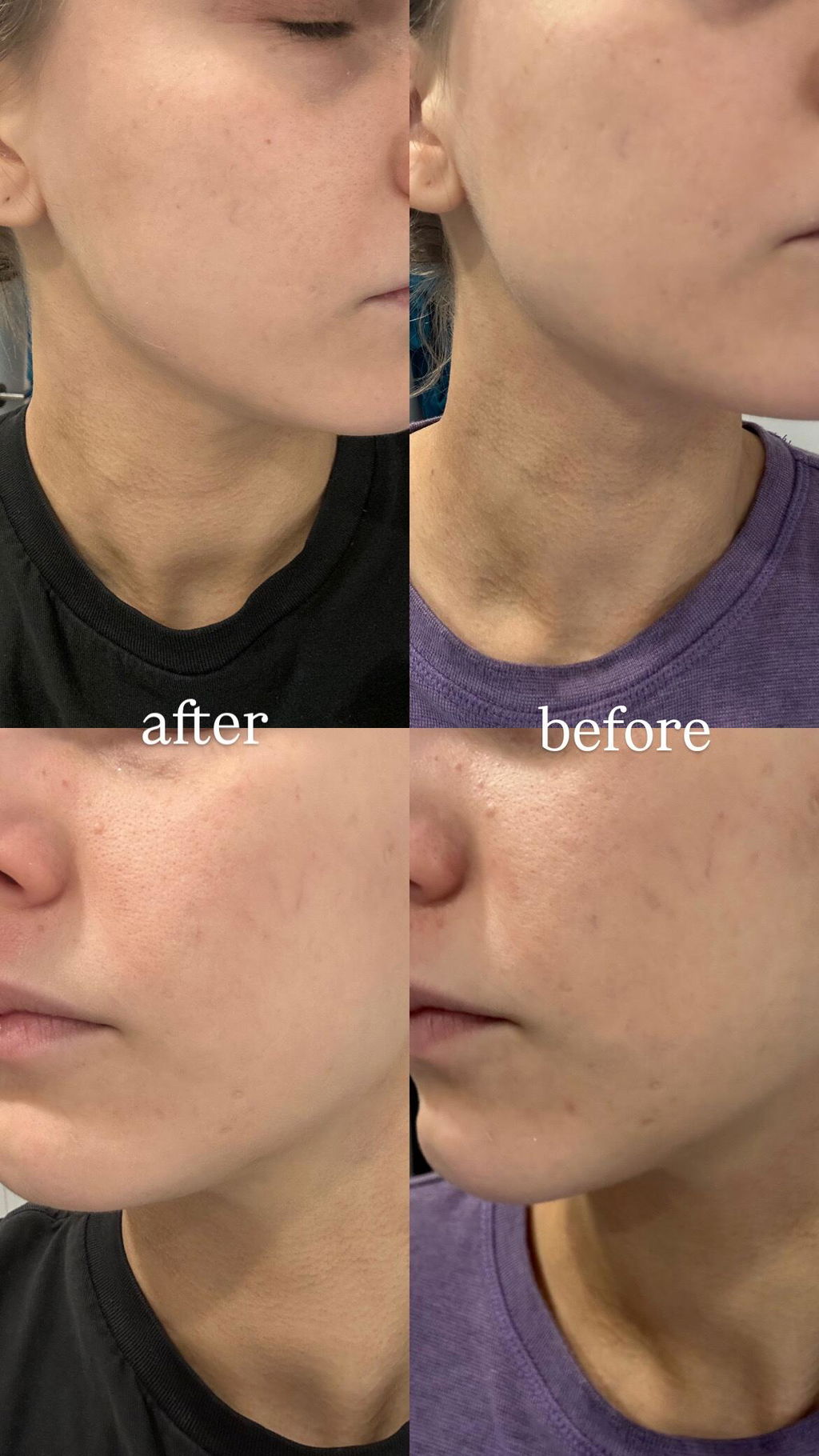 SIGNATURE DUO MIRACLE ALIGNER + 2ND SKIN