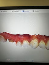 Wireless Intraoral scanner Panda P4