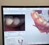 Intraoral scanner Panda P3 Plus