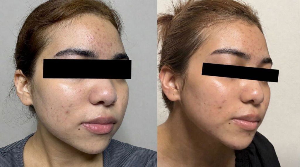 Golden Tomato Oral Sunblock - Best Skin Whitening Supplement | UV Protection, Brighten Skin & Fade Dark Spots