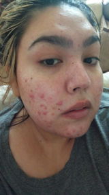 Diphylleiagra review photo