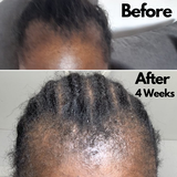 Anoint - Hair Growth Oil For Thinning Hair & Edges
