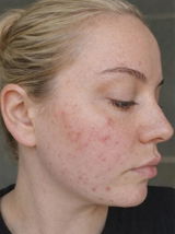 Clear Skin Ritual for Breakouts & Congested Skin