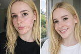 Clear Skin Ritual for Breakouts & Congested Skin