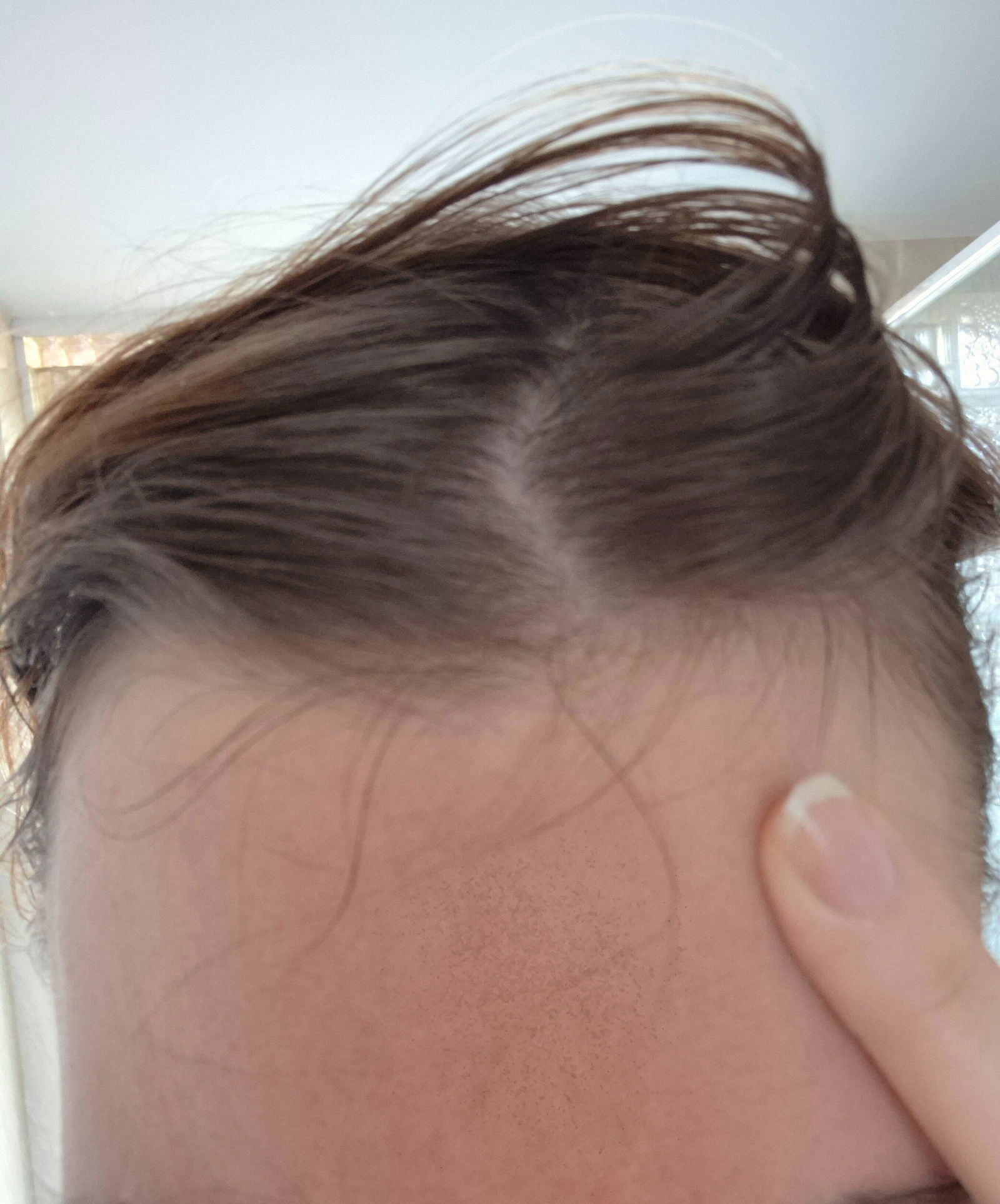Customer photo showing new baby hairs along the hairline