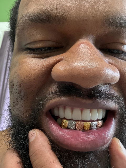 Custom Tri-Tone Diamond Dust And Diamond Cut Grillz