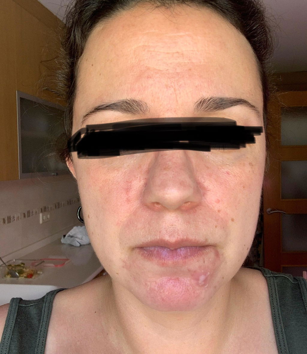 Hydrolina de lavanda para el acné: compre 2 y obtenga 1 gratis