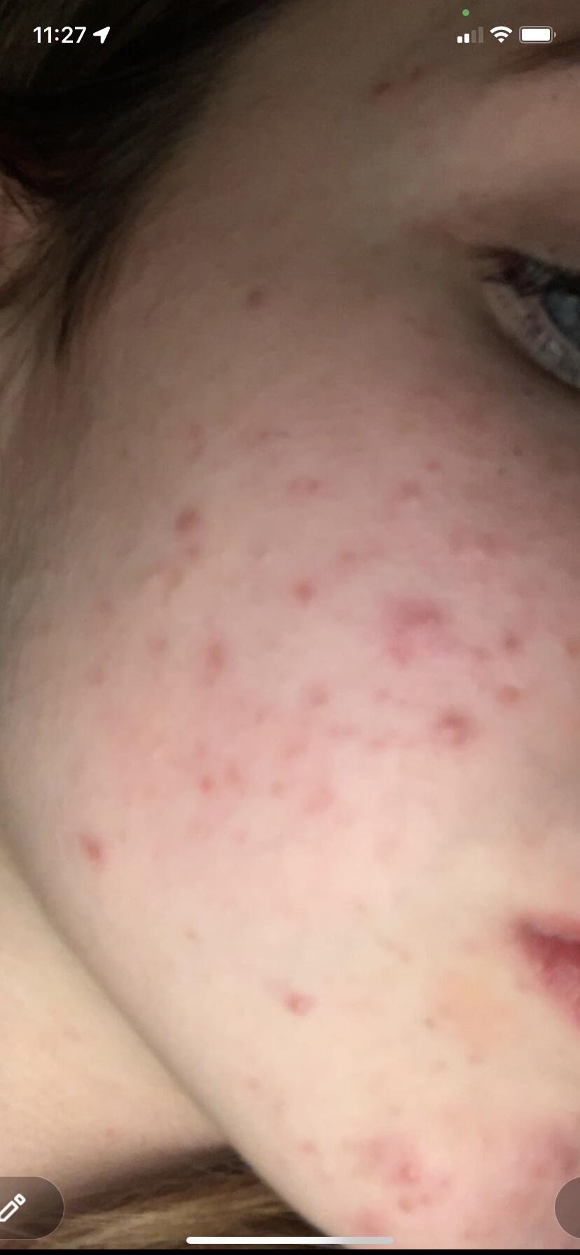 Organic Lavender water - Hydrolina for Acne