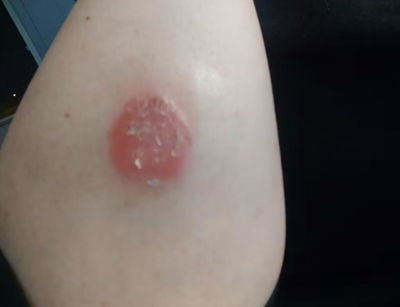 a customer review of the cream for psoriasis and eczema by InaEssentials