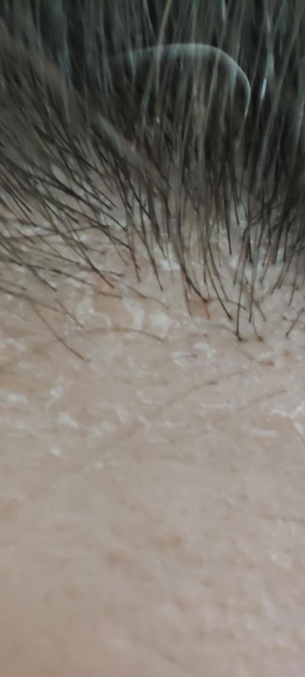 Ekologiškas Šalavijų vanduo - Hydrolina nuo Pleiskanų ir galvos Odos niežėjimo