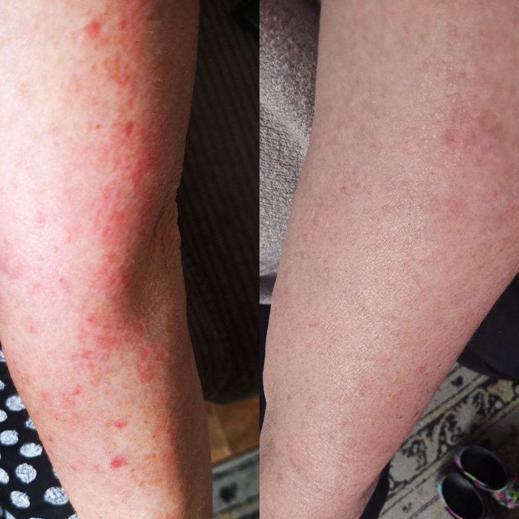 Biologisch Kamillewater - Hydrolina voor Eczeem en Geïrriteerde huid