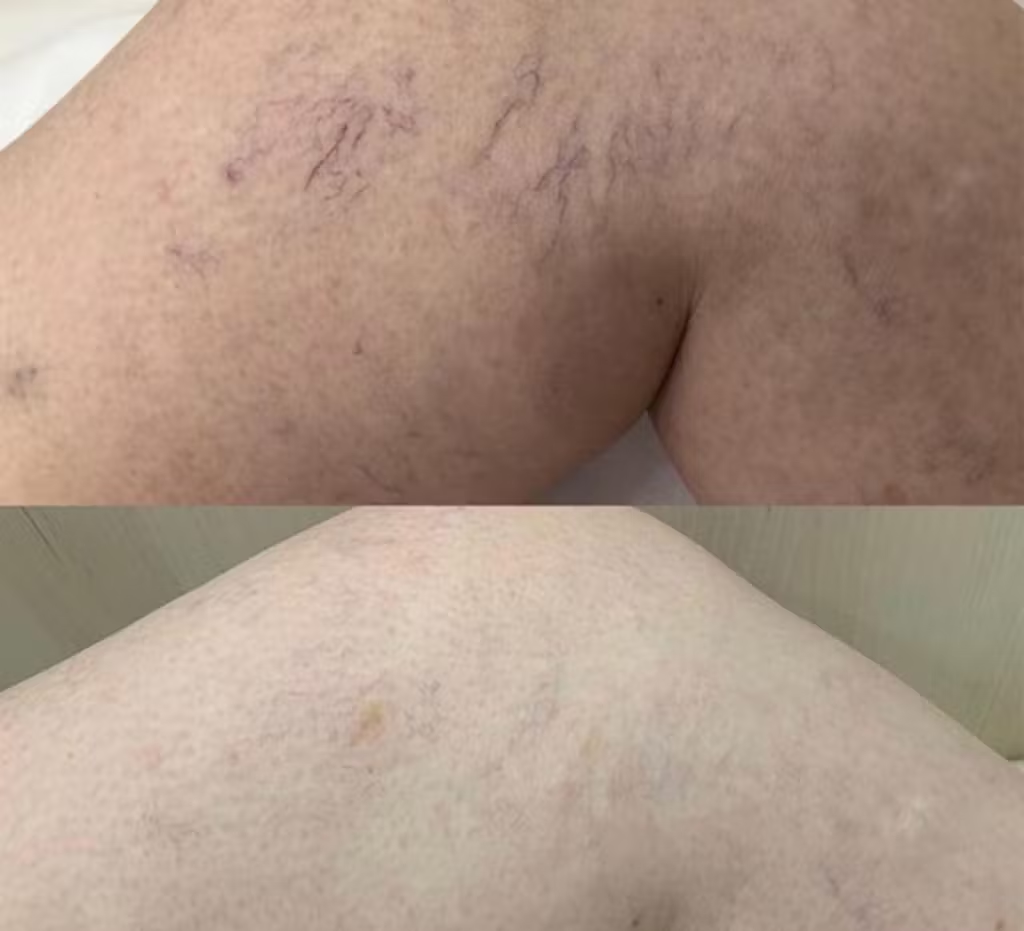 Remorrhoids - crème voor Spataderen en Aambeien - sterk verrijkt met Rookboom en Paardenkastanje