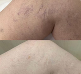 Remorrhoids - creme para Varizes e Hemorróidas - altamente enriquecido com Árvore do Fumo e Castanha de cavalo