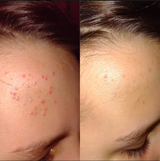 Hydrobiotic - Lavanda e Menta - cuidado intensivo para Acne