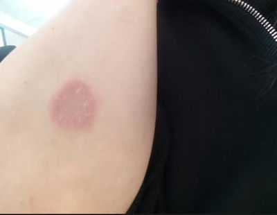 opinião de uma cliente sobre o creme para psoríase e eczema da InaEssentials