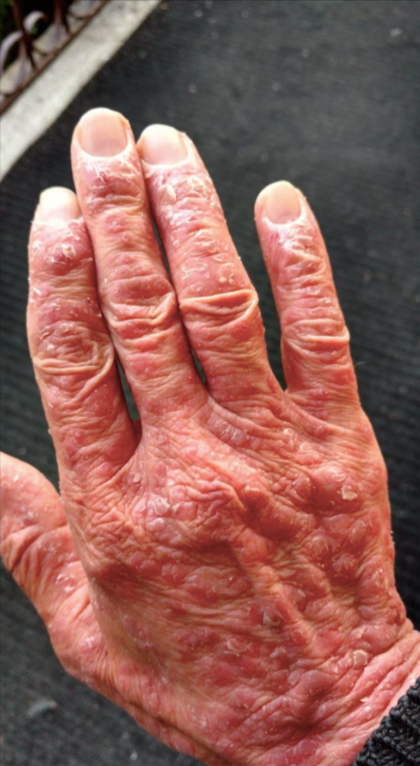 Apă de Sunătoare Sălbatică - Hydrolina pentru Psoriazis si piele Iritată
