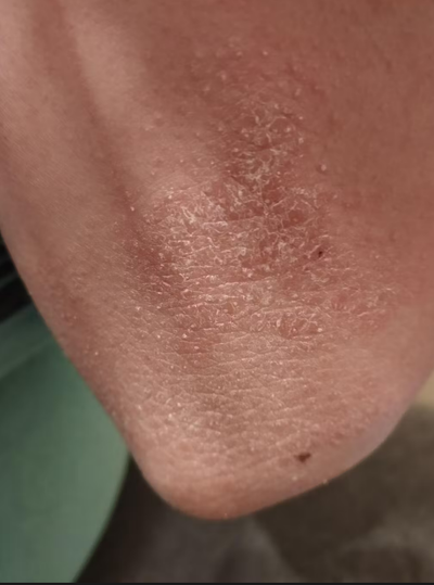 recenzia zákazníčky na krém na psoriázu a ekzém od InaEssentials