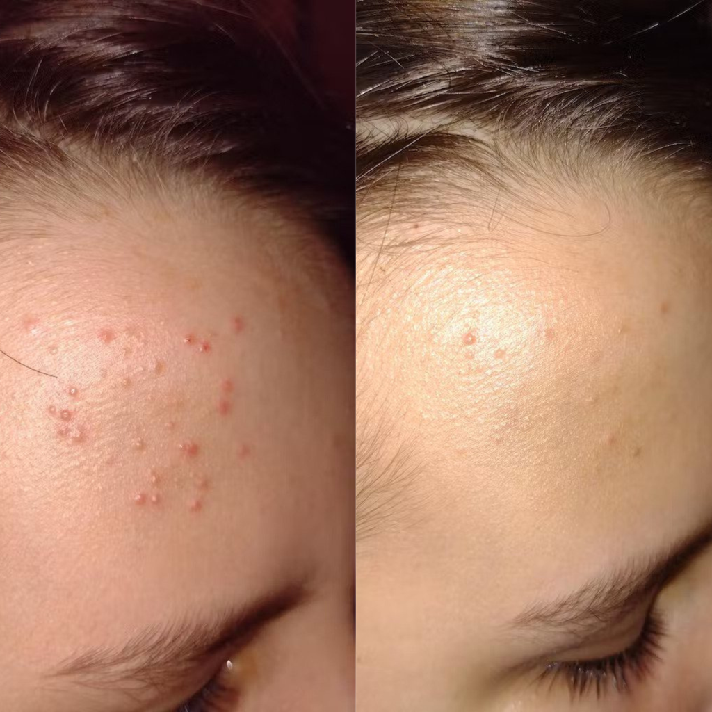 Organic Lavender water - Hydrolina for Acne
