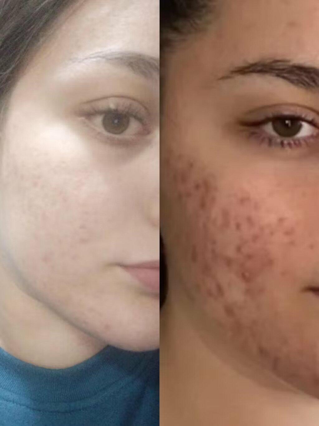 Organic Lavender water - Hydrolina for Acne