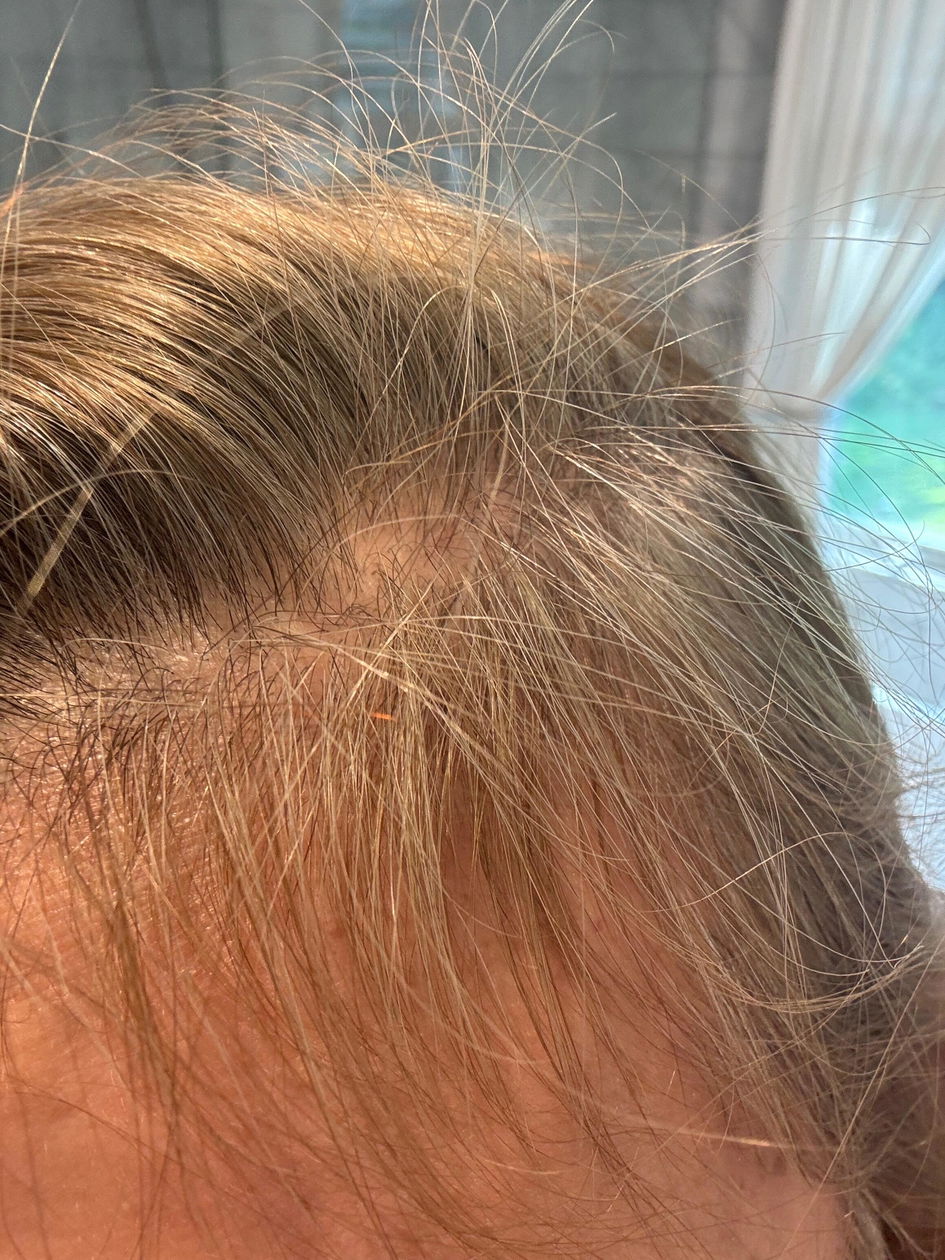 ghk cu hair loss reddit GHK-Cu before and after : r/Biohackers DIY GHK-CU hair growth serum,