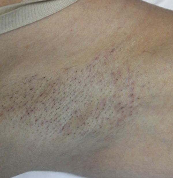 Cyperus rotundus oil customer photo: underarm photo 1 shared with her review (Yasimi M., verified buyer of nellaskin Bare Oil)