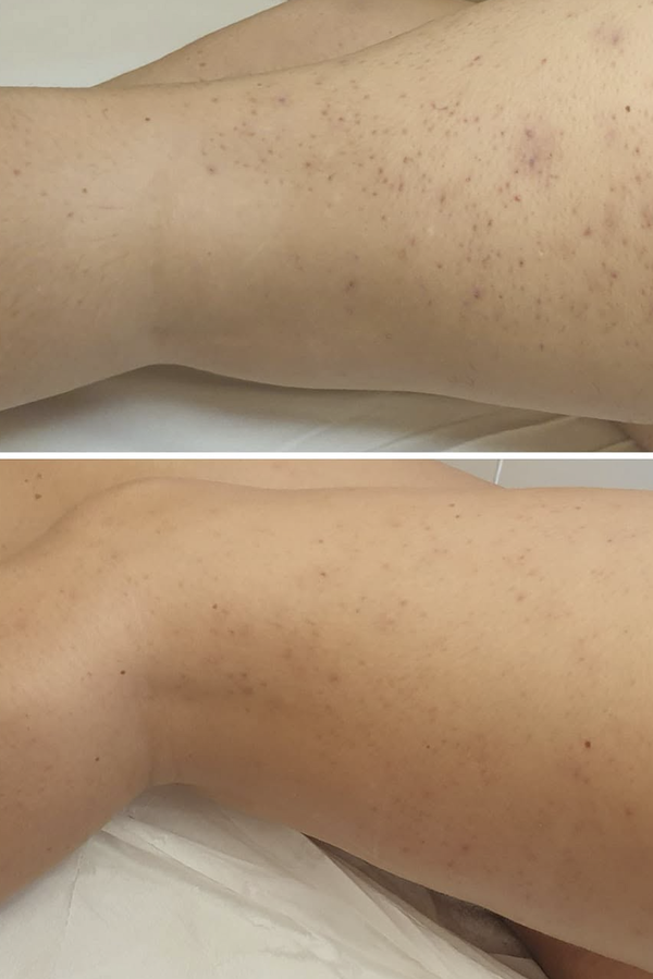 Cyperus rotundus oil customer photo: leg photos shared with her review (Maria G., verified buyer of nellaskin Bare Oil)