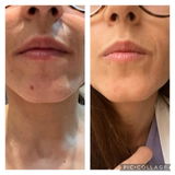 KIT TRATAMIENTO - MANCHAS + GRANITOS + IMPERFECCIONES
