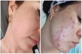KIT TRATAMIENTO - MANCHAS + GRANITOS + IMPERFECCIONES