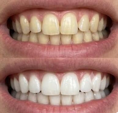 Customer photo review of Premium Teeth Whitening Strips