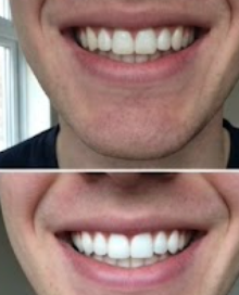 Customer photo review of Premium Teeth Whitening Strips