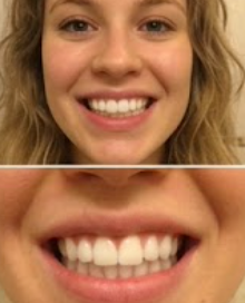 Customer photo review of Premium Teeth Whitening Strips