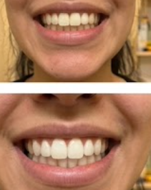 Customer photo review of Premium Teeth Whitening Strips