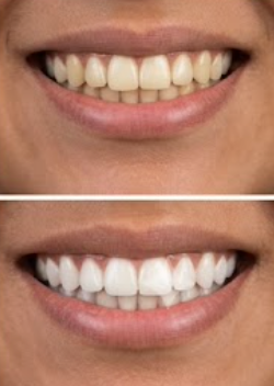 Customer photo review of Premium Teeth Whitening Kit