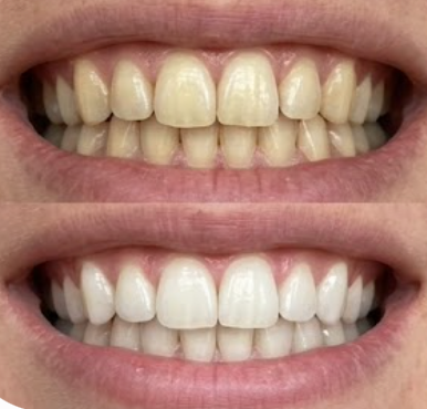 Customer photo review of Premium Teeth Whitening Kit