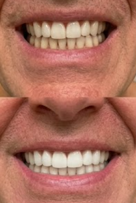 Customer photo review of Premium Teeth Whitening Powder