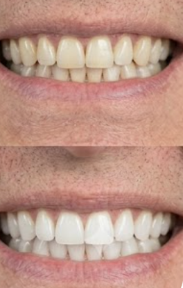 Customer photo review of Premium Teeth Whitening Kit