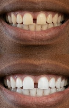Customer photo review of Premium Teeth Whitening Kit