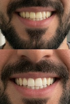Customer photo review of Premium Teeth Whitening Strips
