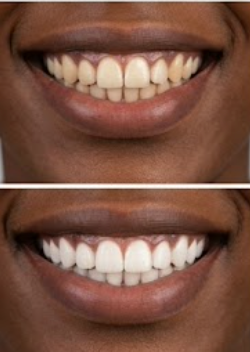 Customer photo review of Premium Teeth Whitening Strips