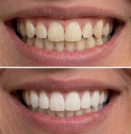 Customer photo review of Premium Teeth Whitening Powder