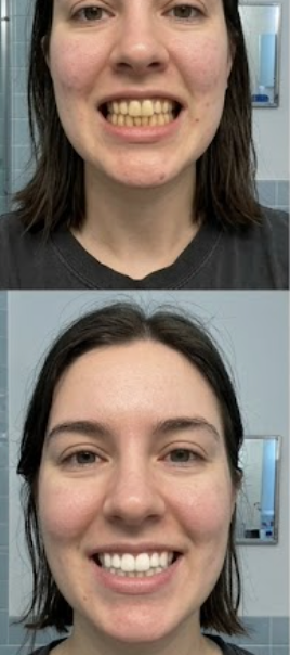 Customer photo review of Premium Teeth Whitening Powder