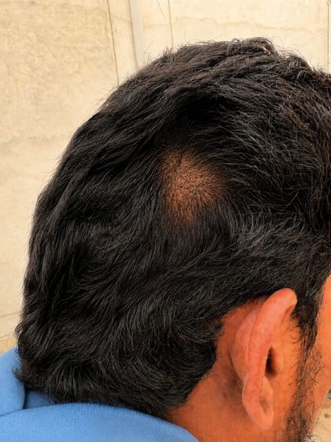 Advanced Ayurvedic Formula for Alopecia Treatment | Doctor Recommended | 100% Safe & Effective
