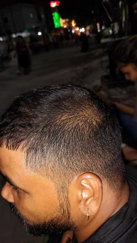 Advanced Ayurvedic Formula for Alopecia Treatment | Doctor Recommended | 100% Safe & Effective
