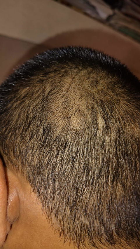 Advanced Ayurvedic Formula for Alopecia Treatment | Doctor Recommended | 100% Safe & Effective