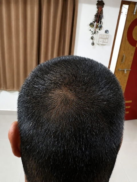 Advanced Ayurvedic Formula for Alopecia Treatment | Doctor Recommended | 100% Safe & Effective