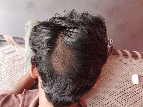 Advanced Ayurvedic Formula for Alopecia Treatment | Doctor Recommended | 100% Safe & Effective