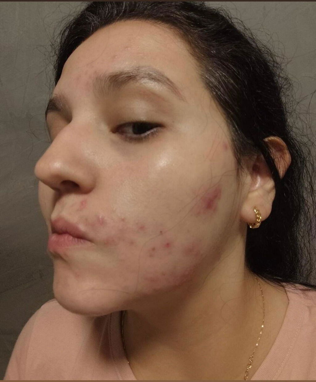 Kit SOS Acne Adulta