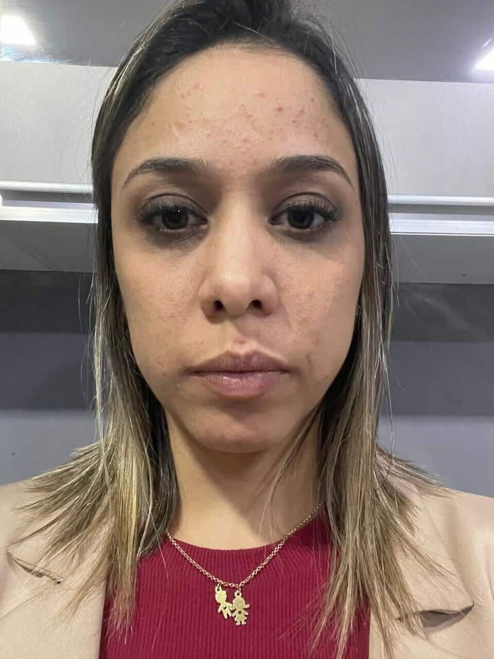 Kit SOS Acne Adulta