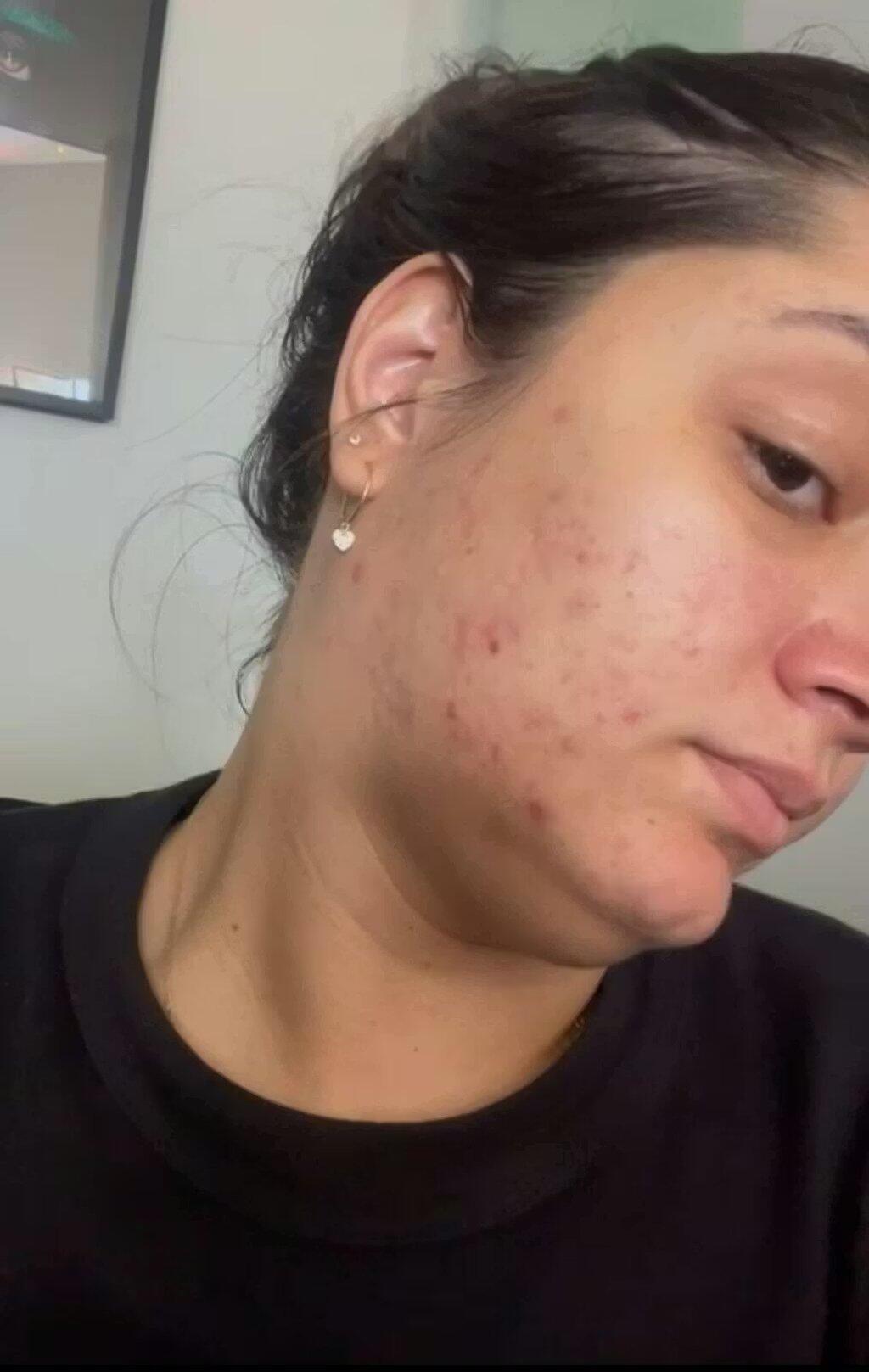 Solução Bakuchiol Anti Idade 5 em 1